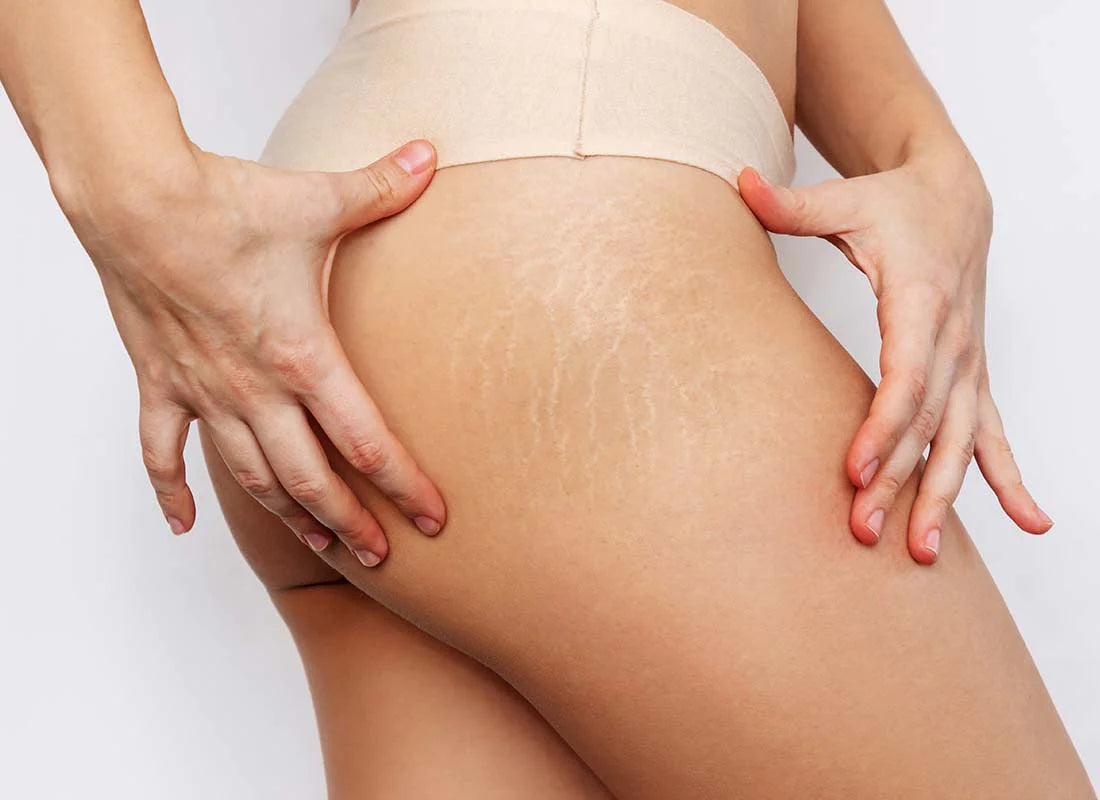 Cellulite Reduction Treatment